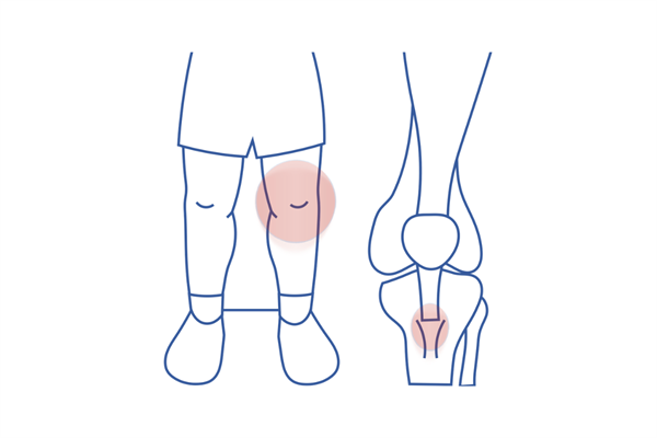 Osgood-Schlatter's disease