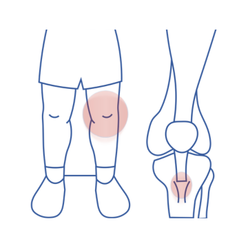 Osgood-Schlatter's disease