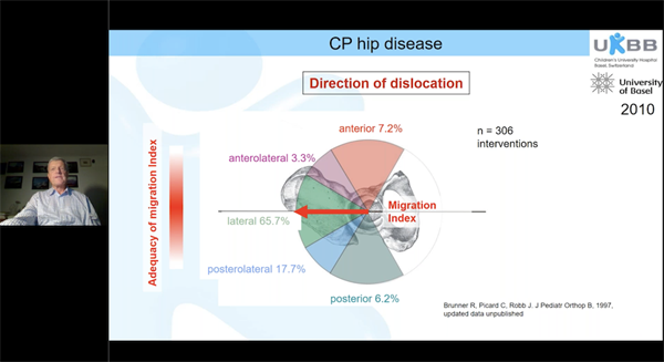 7th EPOS Webinar on Cerebral Palsy: CP Hip Disease: Surveillance and Treatment