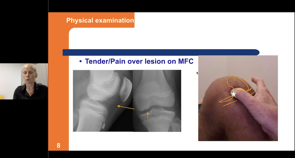 2nd EPOS Webinar – EPOS Sports Study Group WEBINAR Osteochondritis Dissecans