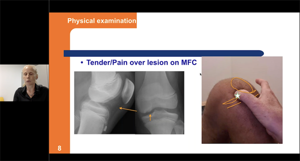 2nd EPOS Webinar – EPOS Sports Study Group WEBINAR Osteochondritis Dissecans