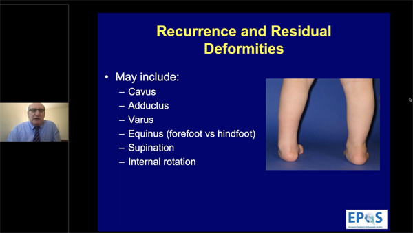 The Recurrent Clubfoot