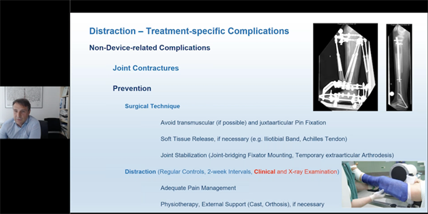 EPOS – POSI Combined Webinar: Common Complications and Their Management in Paediatric Orthopaedics