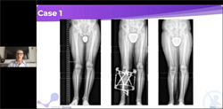 EPOS Industry-Sponsored Webinar: Operative Management of Limb Length Discrepancy Supported by NuVasive