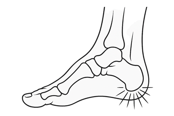 Calcaneal Apophysitis or Sever’s Disease