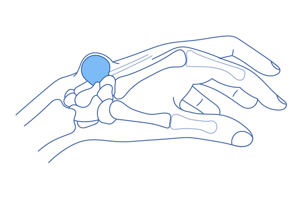 Synovial (Ganglion) Cyst of the Wrist