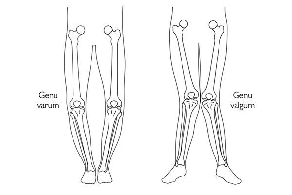 Genu varum (bowlegs) and valgum (knock-knees)