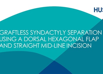 Graftless Syndactyly Separation